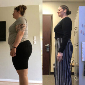 weight-loss-surgery-before-and-after